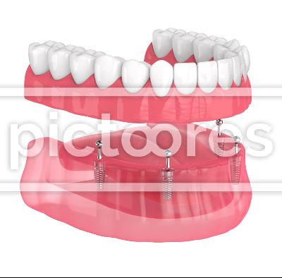 All-on-4 removable overdenture installation supported by implants