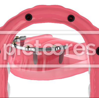 Bar retained removable overdenture installation supported by implants