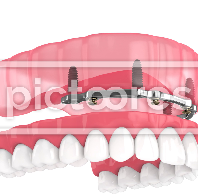 Removable overdenture installation on bar locator, supported by implants