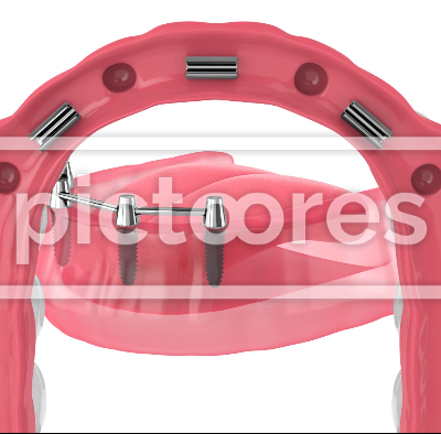 Removable overdenture installation on bar clip attachment, supported by implants