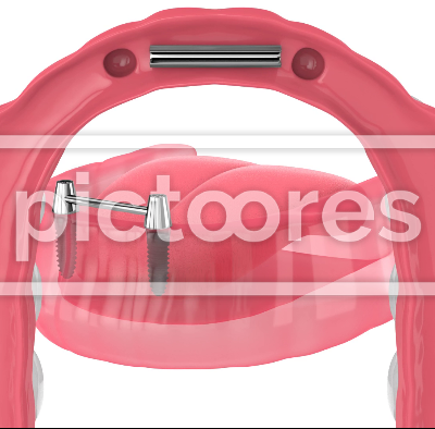 Removable overdenture installation on bar clip attachment, supported by implants