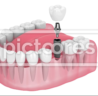Lower jaw with dental implant installation procedure