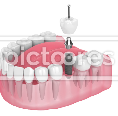 Dental implant installed into lower jaw