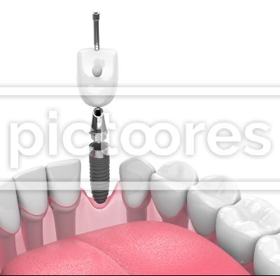 Dental implant installation into lower jaw