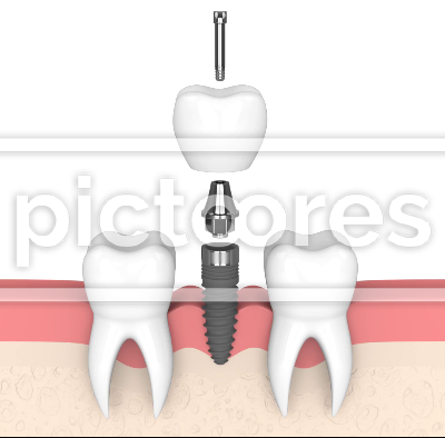 Dental implant placement into human gums