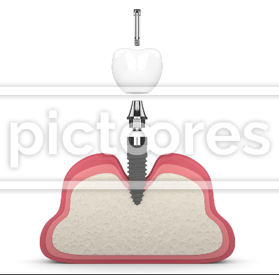 Dental implant placement into human gums over white background
