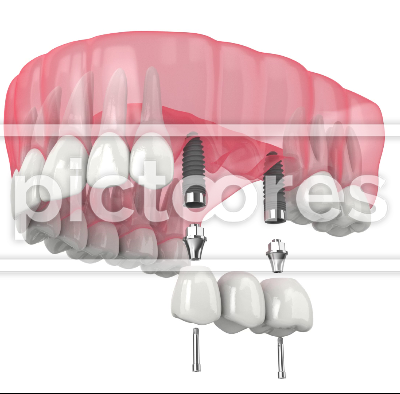 Upper jaw with dental bridge supported by implants