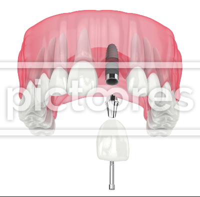 Upper jaw with incisor dental implant placement