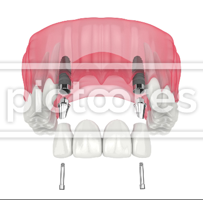 Upper jaw with dental bridge supported by implants