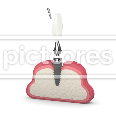 Human gum with incisor dental implant installation