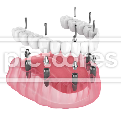 Dental prosthesis all-on-6 system supported by implants