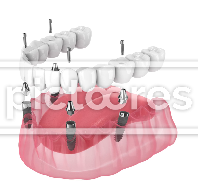 Dental prosthesis all-on-4 system supported by implants