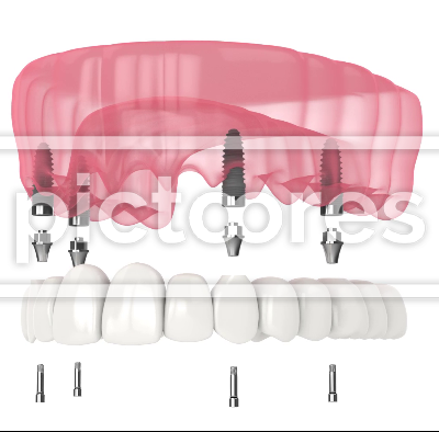 Dental prosthesis all-on-4 system supported by implants