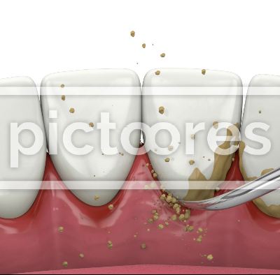 Removing tartar and plaque from teeth by ultrasonic scaler