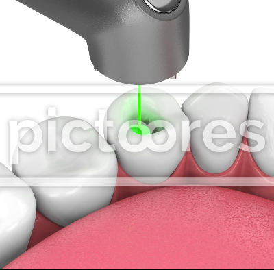 Removing tooth decay with dental laser