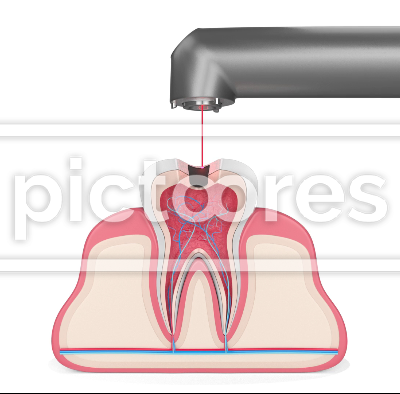 Removing tooth decay with dental laser