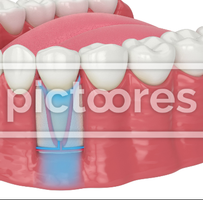 Human jaw with intraligamentary anesthesia procedure