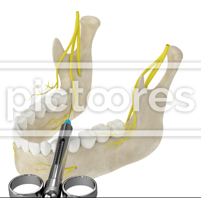 Mandibular arch with inferior alveolar nerve block