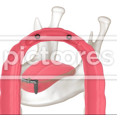 Bar retained removable overdenture installation supported by two implants