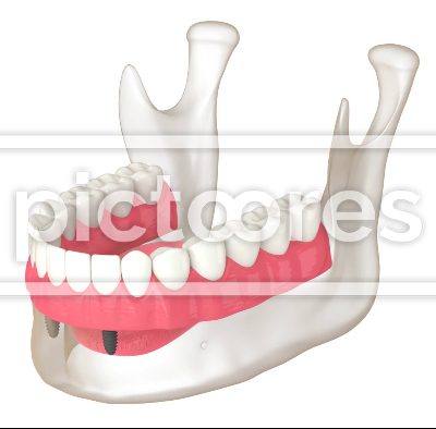 Dental overdenture
