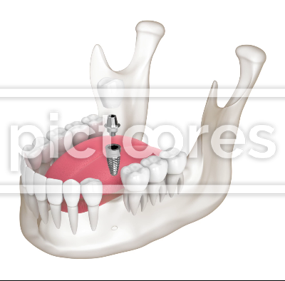 Mandible with dental implant placement