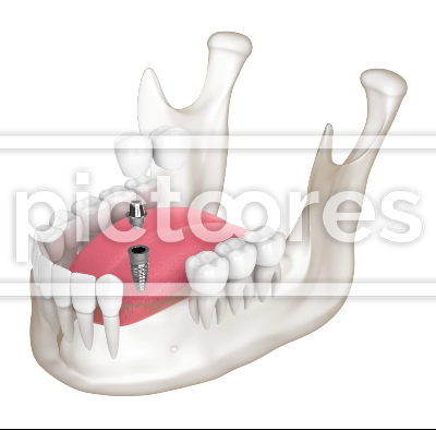 Mandible with implant supported dental cantilever bridge