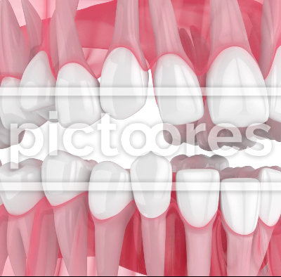 Human jaw with crooked teeth straightening