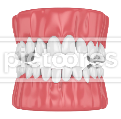 Human jaw with crooked teeth straightening