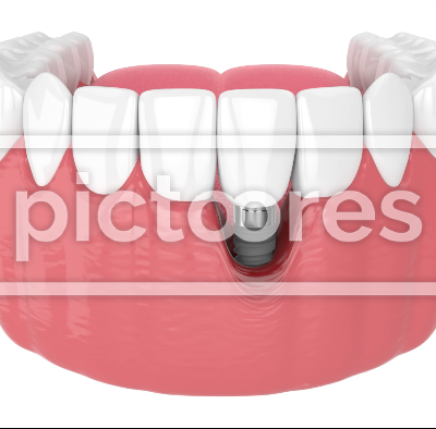Human jaw with peri implantitis disease over white background
