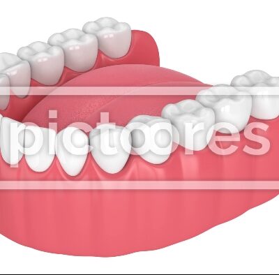 Lower jaw with peri implantitis disease and periodontal sonda