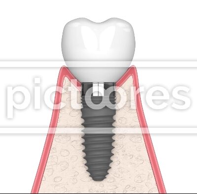 Peri-implantitis disease in human gums