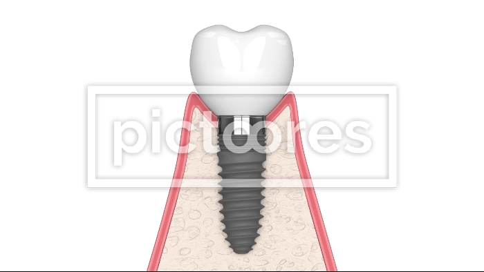 Peri-implantitis disease in human gums