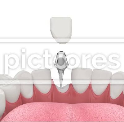 Premolar restoration with cast post and core