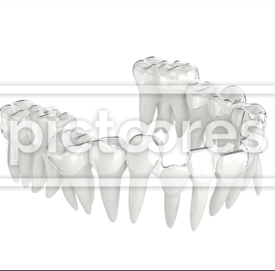 Orthodontic clear aligner