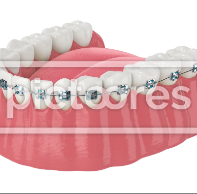 Teeth aligning by orthodontic braces