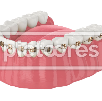 Golden orthodontic braces aligning teeth