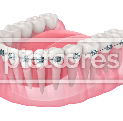 Teeth alignment by orthodontic braces