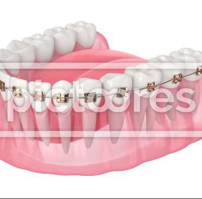 Teeth alignment by orthodontic braces
