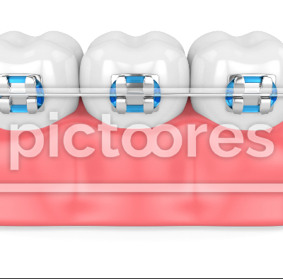 Teeth with dental orthodontic braces
