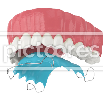 Upper jaw with orthodontic removable retainer