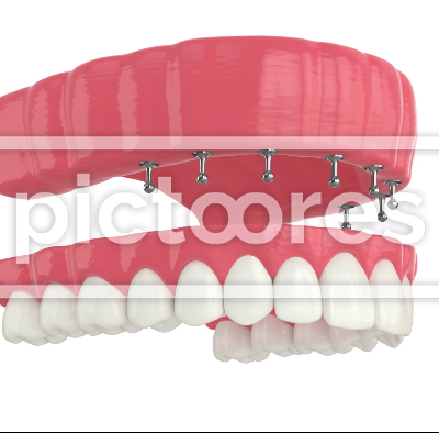 Removable snap-on full implant denture installation