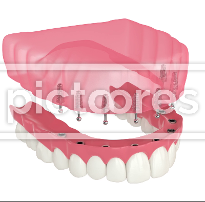 Removable snap-on full implant denture installation