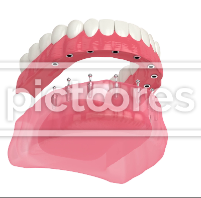 Removable snap-on full implant denture installation