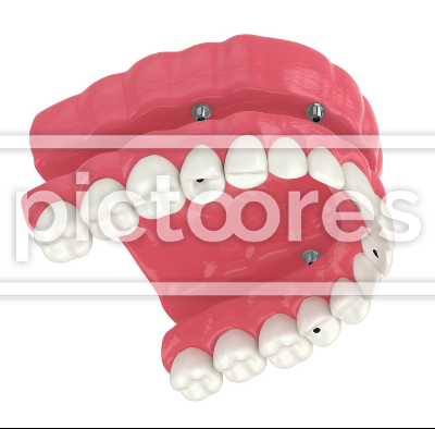 All-on-4 denture treatment