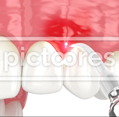 Dental diode laser used to treat gums