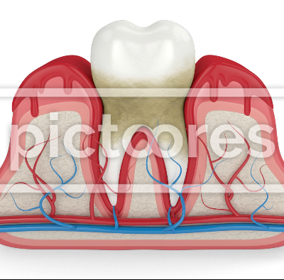 Tooth with tartar and bleeding gums