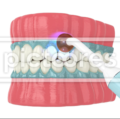 Professional teeth bleaching