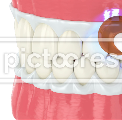 Professional teeth whitening by lamp