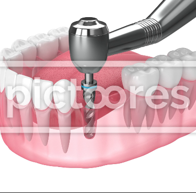 implant supported dental cantilever bridge procedure