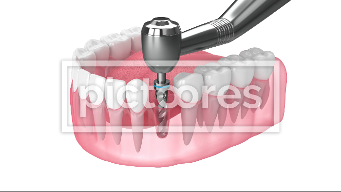 dental implant post placement